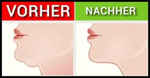 7 effektive Übungen, um ein Doppelkinn zu reduzieren und jünger auszusehen 