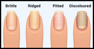 The Shocking Truth Fingernails Reveal About Your Health 