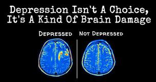 New Research Shows Depression Causes Brain Damage, Not The Other Way Around 