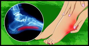 If You Suffer From Foot Pain, You Need To Learn About Plantar Fasciitis