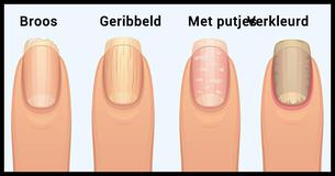 De schokkende waarheid die je vingernagels over je gezondheid onthullen 