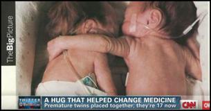 Nurse Puts Dying Baby Next To Her Twin. She Gives Her A ‘Hug’ That Leads To A Miracle