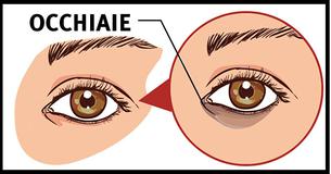 5 metodi naturali per eliminare le occhiaie 